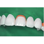 Amarrilho-para-isolamento-absoluto-c-12---Angelus