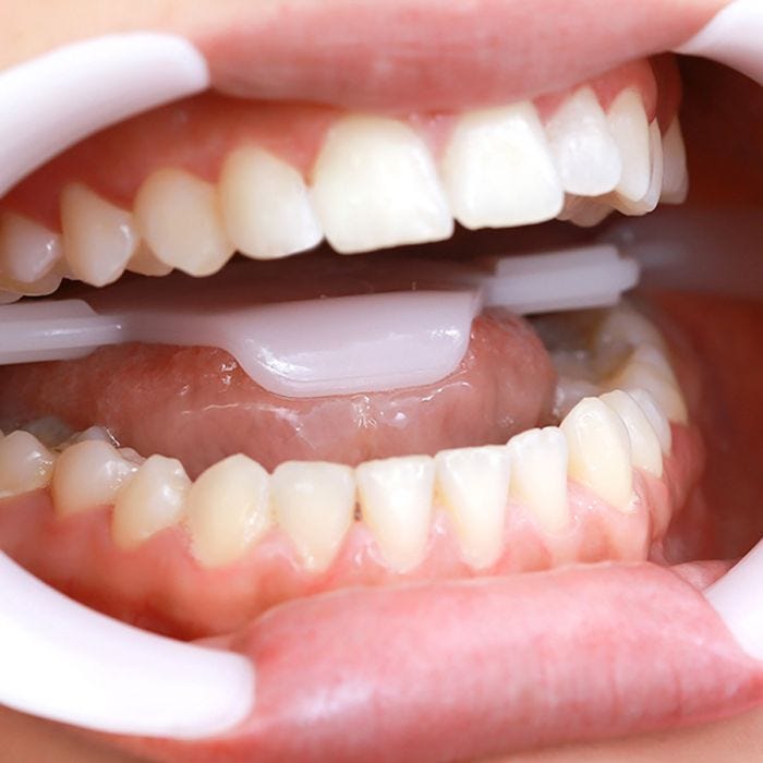 afastador_labial_arcflex_fgm_75011393_5_695eac91f422b4d30e366a14d1dec78c-2.jpg