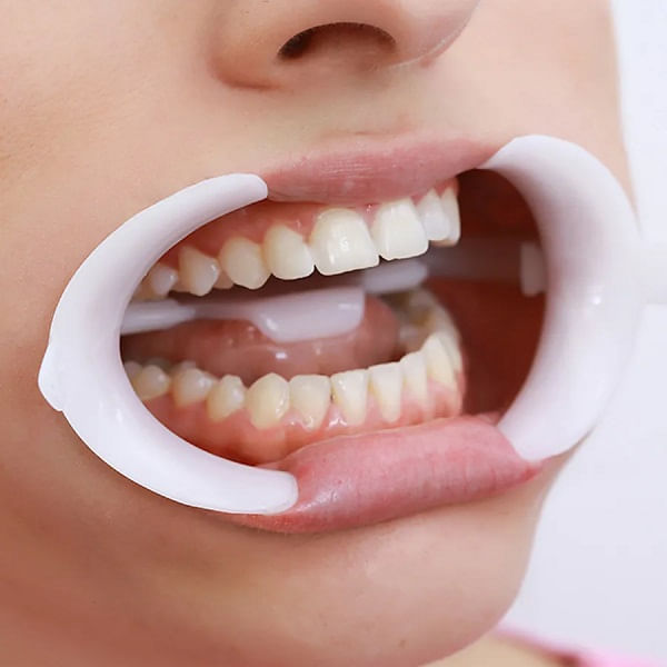demontracao-de-uso-do-afastador-labial-arcflex-fgm-dc11377-dental-cremer.jpg