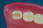 dente-38-para-manequim-de-dentistica-classe-ii-na-face-od-pronew-1647019405681-0--1-.jpg