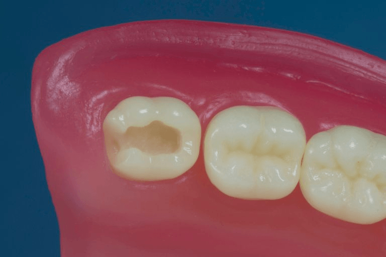 dente-38-para-manequim-de-dentistica-classe-ii-na-face-od-pronew-1647019405681-0--1-.jpg
