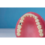 dente-15-para-manequim-de-dentistica-classe-i-na-face-oclusal-cariado-pronew-1646856507190-0--1-.jpg
