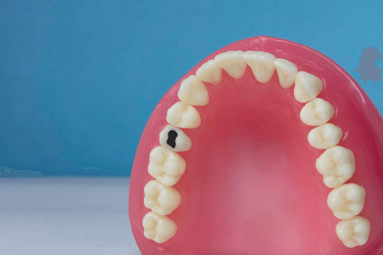 dente-15-para-manequim-de-dentistica-classe-i-na-face-oclusal-cariado-pronew-1646856507190-0--1-.jpg